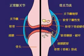 关节不好　服氨糖有用吗图片