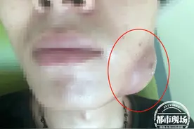 智齿发炎不重视，小伙脸上长出超大脓肿！医生：这些人尽早拔除图片