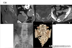Case50 骶尾部恶性肿瘤图片