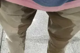 腰椎间盘突出会导致大小便失禁？并发马尾综合征不可忽视图片