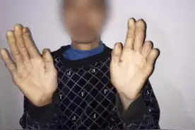 触目惊心！他被骗进黑工厂，断了三根手指图片