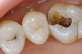 了解这几种牙痛的症状，对症治疗才能缓解牙痛图片