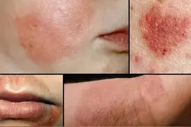 得湿疹后，她犯了个大忌！把治血癌的医生都惊动了...图片
