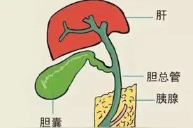 胆囊结石是怎样形成的？图片