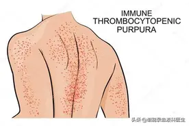 谢别录：ITP患者输的血小板能存活多久？图片