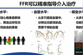 要不要做心脏介入治疗，有了“中国标准”中山医院葛均波院士发起的SUPREME研究取得新进展图片
