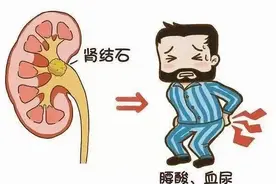 【超声科普】肾结石那些事儿图片