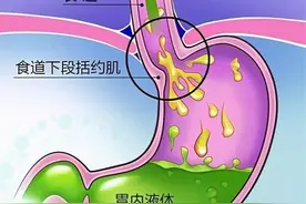 总是反酸烧心怎么办？三个小方法，帮你缓解胃食管返流图片
