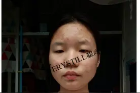 本人八年战痘血泪史，你有耐心看完嘛？图片