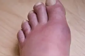 体检发现尿酸高，怎么办？不要慌张，每天泡一杯，尿酸慢慢降下来图片