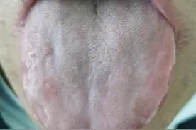 从一张舌头照片上，可以看出多少健康问题？图片