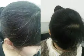 “少年白”为何越来越多？并非肾气不足，而是这4件事没做好图片