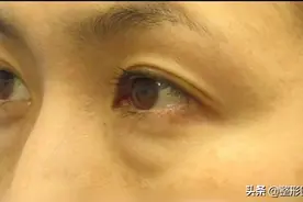 外切祛眼袋+眶隔脂肪释放，没想到"变化这么大"图片