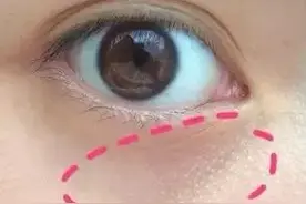 不花钱的方法，一招去脂肪粒！眼部长脂肪粒的原因？图片
