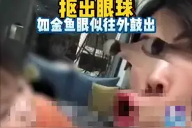 浙江6岁男孩模仿短视频特效，竟自抠眼球，如今眼球鼓出图片