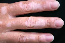 白癜风疾病是什么原因引起的？图片