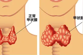 烦躁失眠、食欲旺盛、暴瘦忽胖，可能是甲亢图片