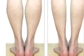 还在为两腿粗细不一致而烦恼？快来看看！你的腿还有救没图片