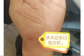 微创治疗腕舟骨骨折--国内最新技术图片
