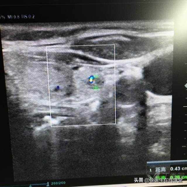 甲状腺结节有什么忌口 2026年甲状腺结节10大忌口＂,＂no_ai_sug＂:true},{＂