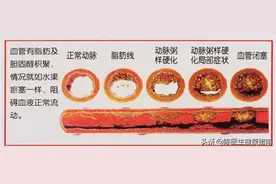 动脉硬化≠动脉粥样硬化，学好软化血管的3步骤，血流通畅少堵塞图片