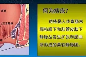 痔疮到底该不该做手术？做过的人会后悔吗？颠覆很多人想象图片