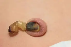 宝宝的脐带怎么还不掉？图片