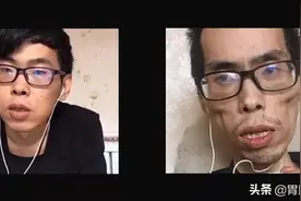 晚期肠癌到底有多可怕？34岁帅哥，患癌1年变干瘦老人…图片