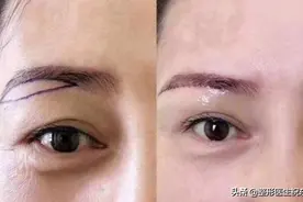 想做“提眉手术”的人，听医生讲讲这25个真相图片