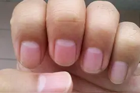 传统医学中指甲异常的代表意义图片