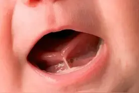 小孩要减舌系带？什么情况要做舌系带手术呢？图片