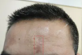 车祸疤痕应该怎么处理？图片