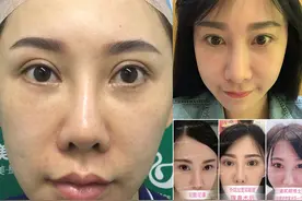 割双眼皮和隆鼻通通都失败，整什么坏什么，整形运气太过差？图片