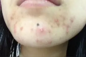 下巴长痘痘又痛又难看，该怎么解决呢？一文告诉你图片