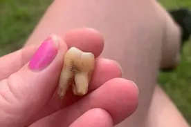 英国女子牙痛得三天睡不着觉，猛灌4瓶啤酒壮胆用菜刀和牙线拔牙图片