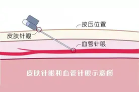 别大意啦，针眼按压是门“技术活”！图片