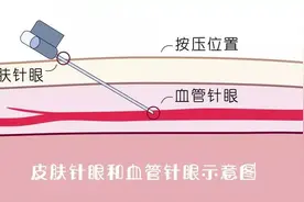 别大意啦，针眼按压是门“技术活”！图片