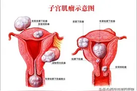 #健康科普汇#【子宫肌瘤患者的饮食注意事项——3】图片