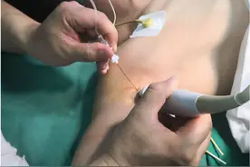 狐臭病人手术，医生护士苦不堪言图片