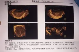 子宫内膜息肉是怎么回事？影响怀孕吗？专家这样说图片