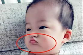 1岁儿子总撅“金鱼嘴”，妈妈还在夸可爱，奶奶掰开嘴后直奔医院图片