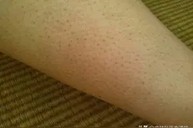 皮肤科医生和你聊聊：“鸡皮肤”需要治疗吗？能怎么治疗？图片
