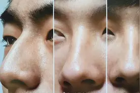 男女隆鼻的相同与差异，体现在哪些方面图片