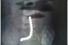 1岁女宝误吞磁力珠肠穿孔，同济专家呼吁：儿童应严格禁止接触磁力珠图片