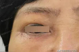 做过眼袋手术后的人公开的20个细节图片