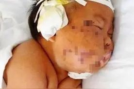 宝宝因吃奶太用力，被妈妈用剪刀“刮花脸”，4年后原因才被披露图片