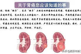 专家解读 | 关于肾癌您应该知道的事图片