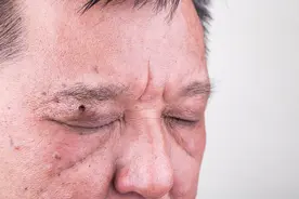 什么样的痣会是癌？9个症状可能是暗示，值得警惕图片