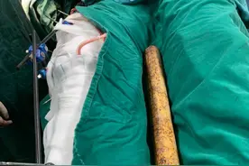 惊险！江西一工人如厕遭遇祸从天降 钢管掉落贯穿身体图片