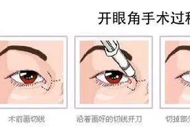 为什么做双眼皮的时候医生建议还要开个眼角？图片